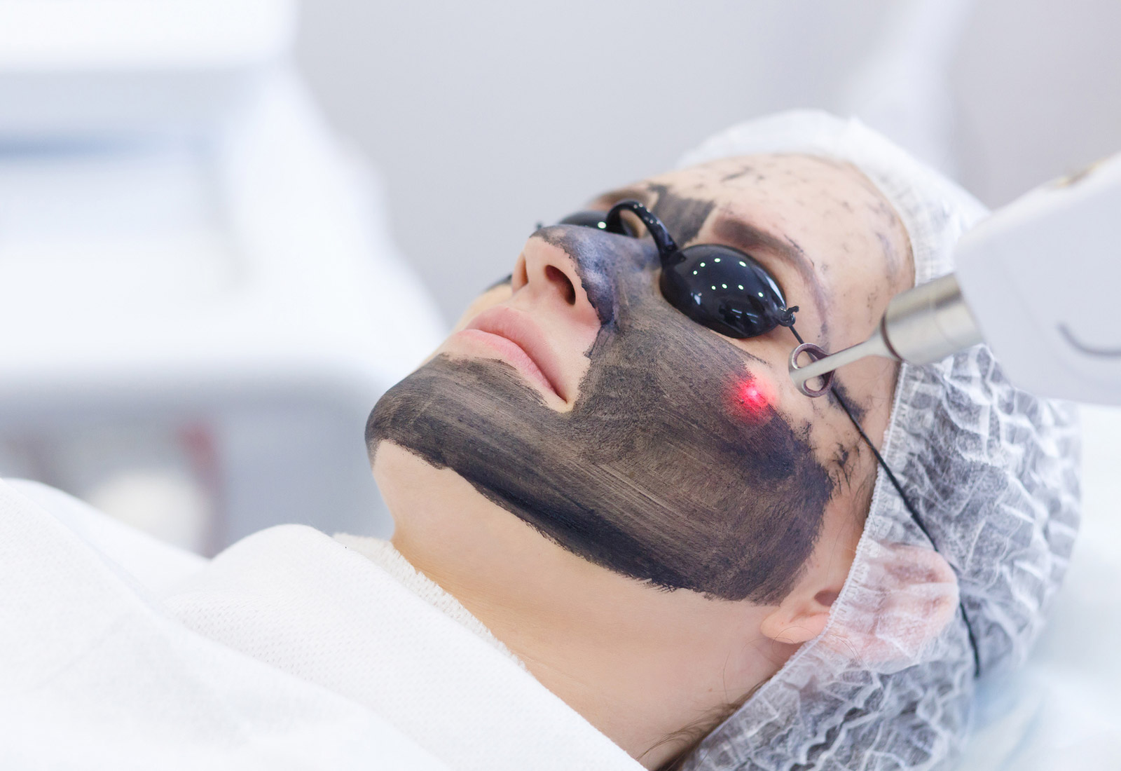 hollywood-laser-peel-peeling carbon bilbao