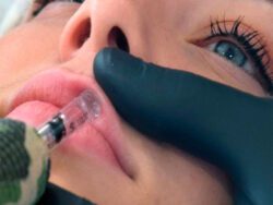 relleno hyaluron pen labios bilbao
