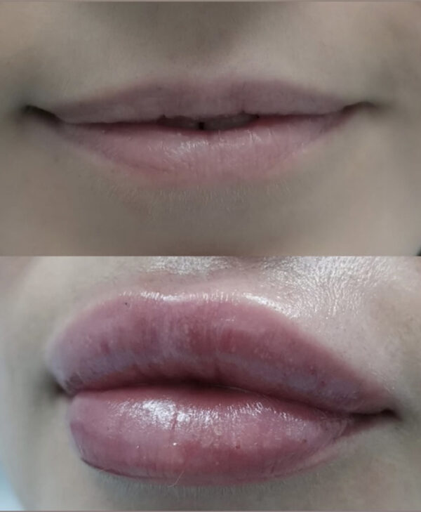 mejor relleno labios hialuronico bilbao hyaluron pen bizkaia vizcaya